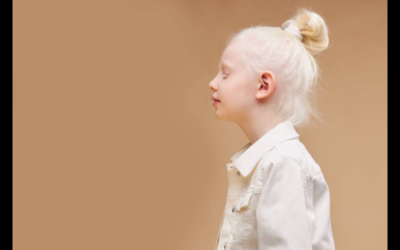 ilustrasi albino (pixabay)