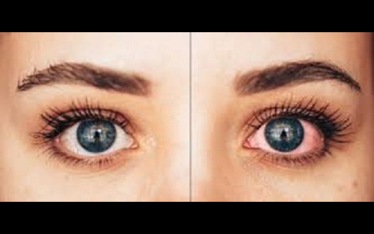 ilustrasi Uveitis (Pinterest)