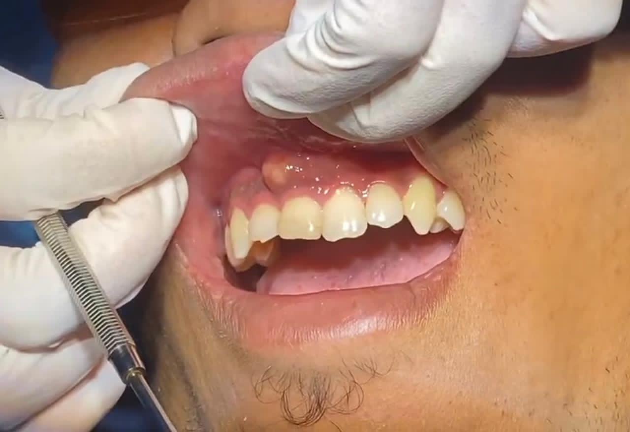 ilustrasi abses gusi.