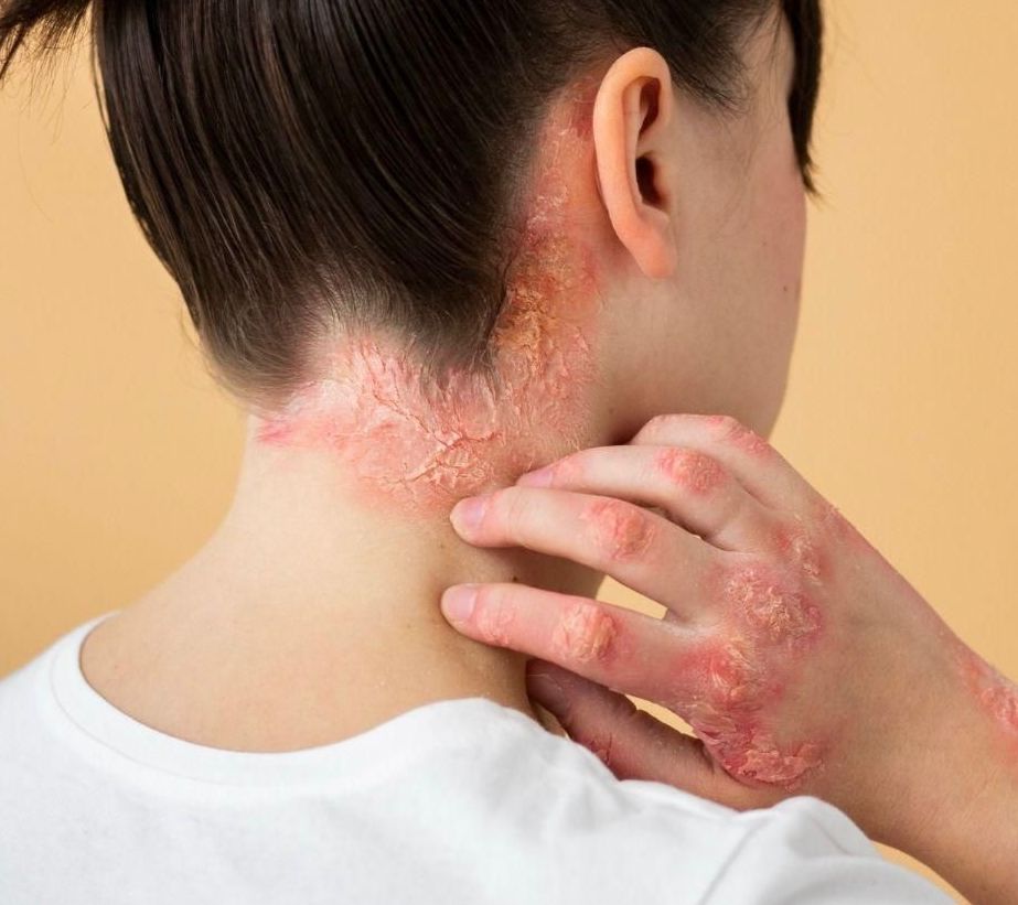 Ilustrasi penyakit outoimun menyrang tubuh.