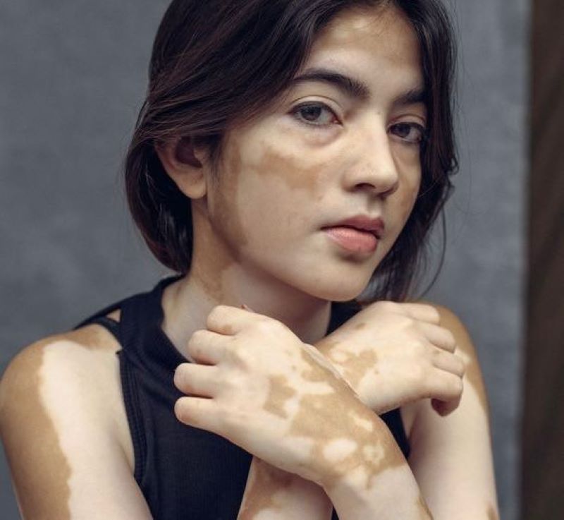 Ilustrasi penyakit vitiligo pada tubuh.