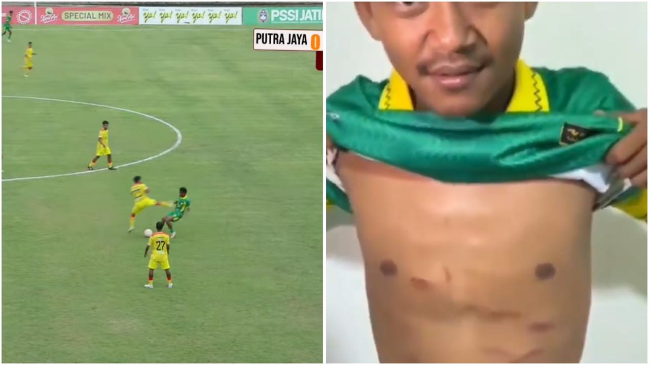 Tendangan kungfu dari salah satu pemain PS Putra Jaya terhadap Firman, pemain Perseta, membuat dadanya mengalami beberapa luka dan lebam. (Youtube/PSSI Jawa Timur & X/mohammed ali mahrus)