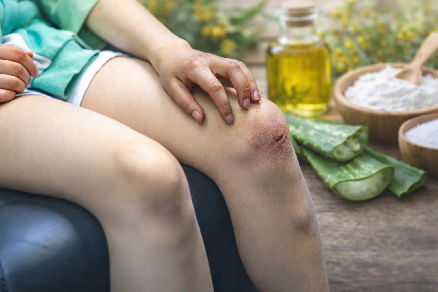 Bahan Alami yang bisa menghilangkan bekas luka. (AI/Pinterest)