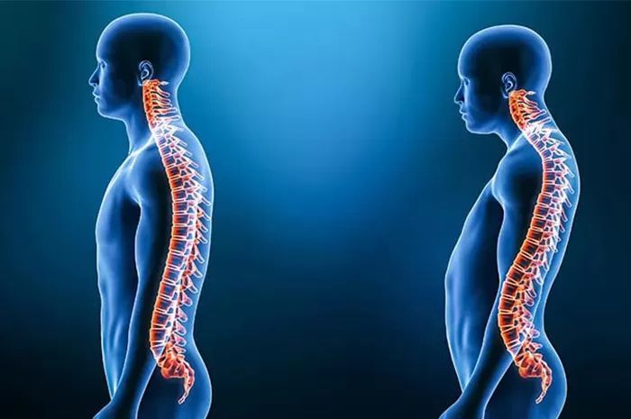 Ilustrasi duduk terlalu lama dan salah posisi bisa picu lordosis. (Dilansir dari Radar Mojokerto)