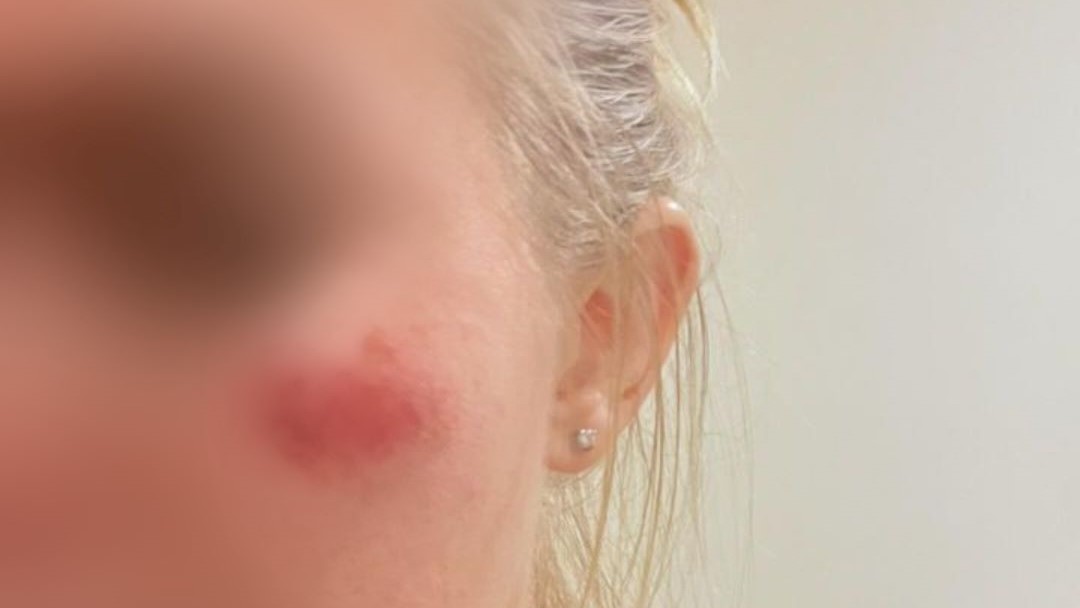 Wanita Ukraina korban kekerasan di Bali mengalami penderitaan secara fisik dan psikis.
