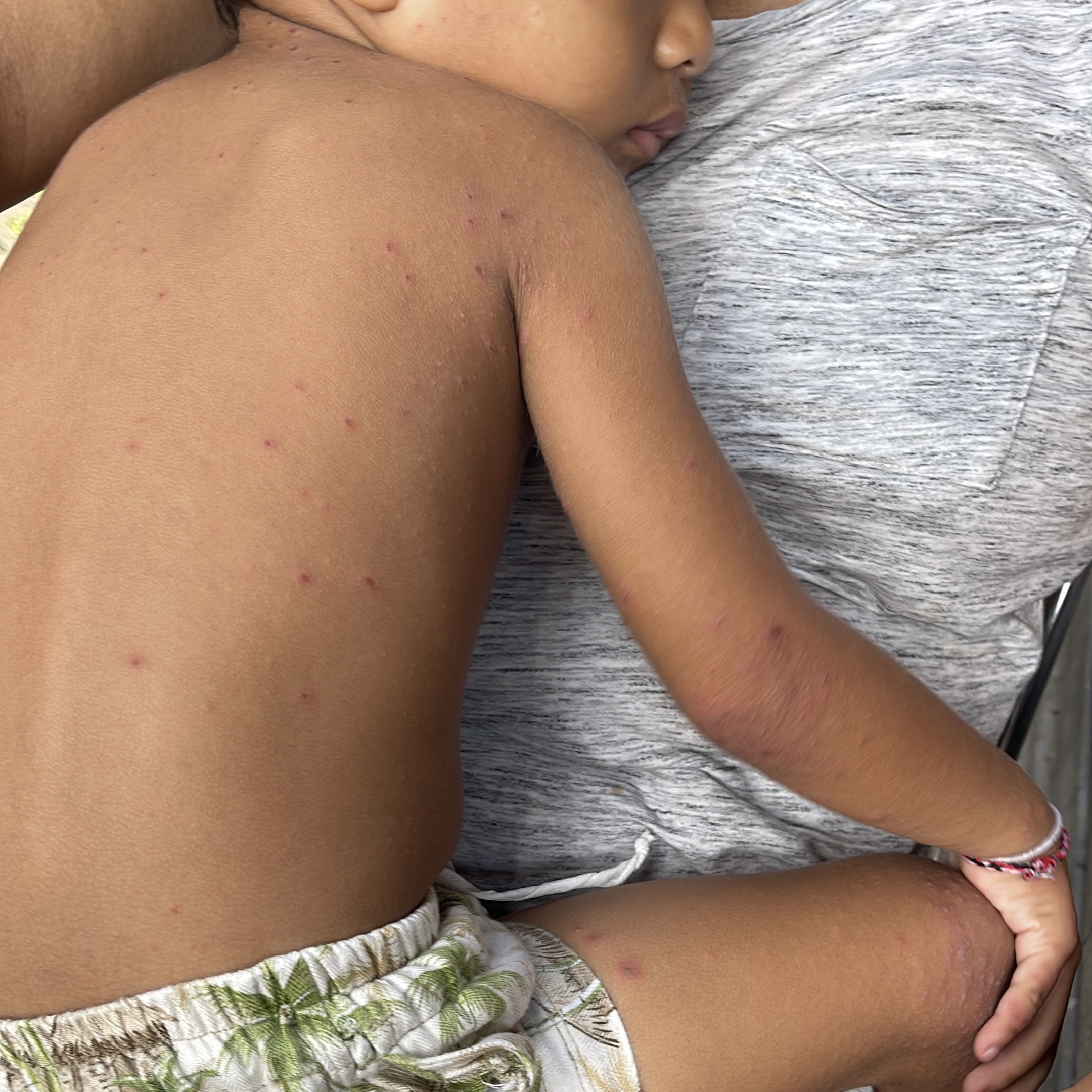 Gejala  ruam pada bagian tubuh akibat flu singapura yang banyak menyerang anak-anak di Kabupaten Jembrana.