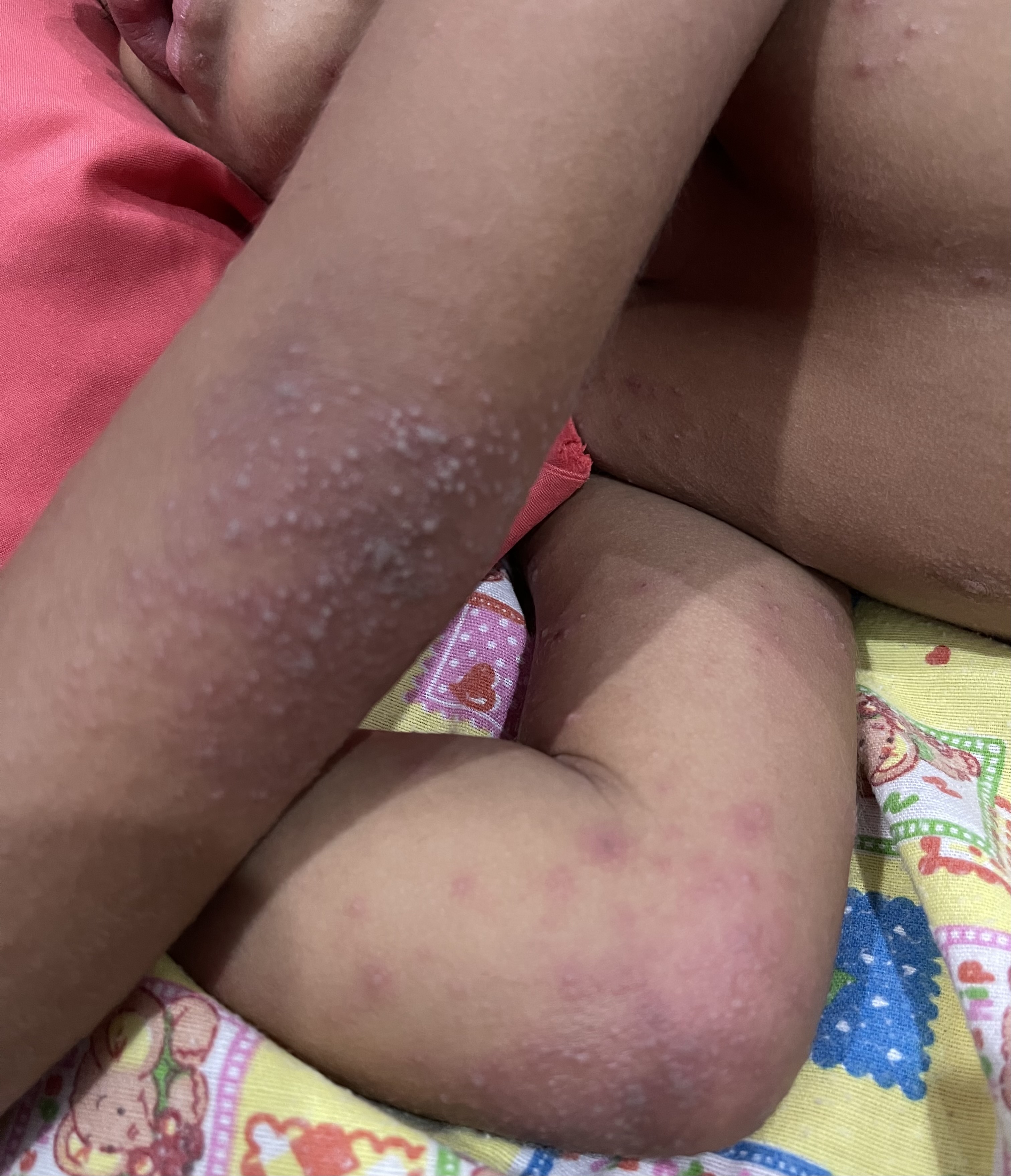Gejala  ruam pada siku akibat flu singapura yang banyak menyerang anak-anak di Kabupaten Jembrana.
