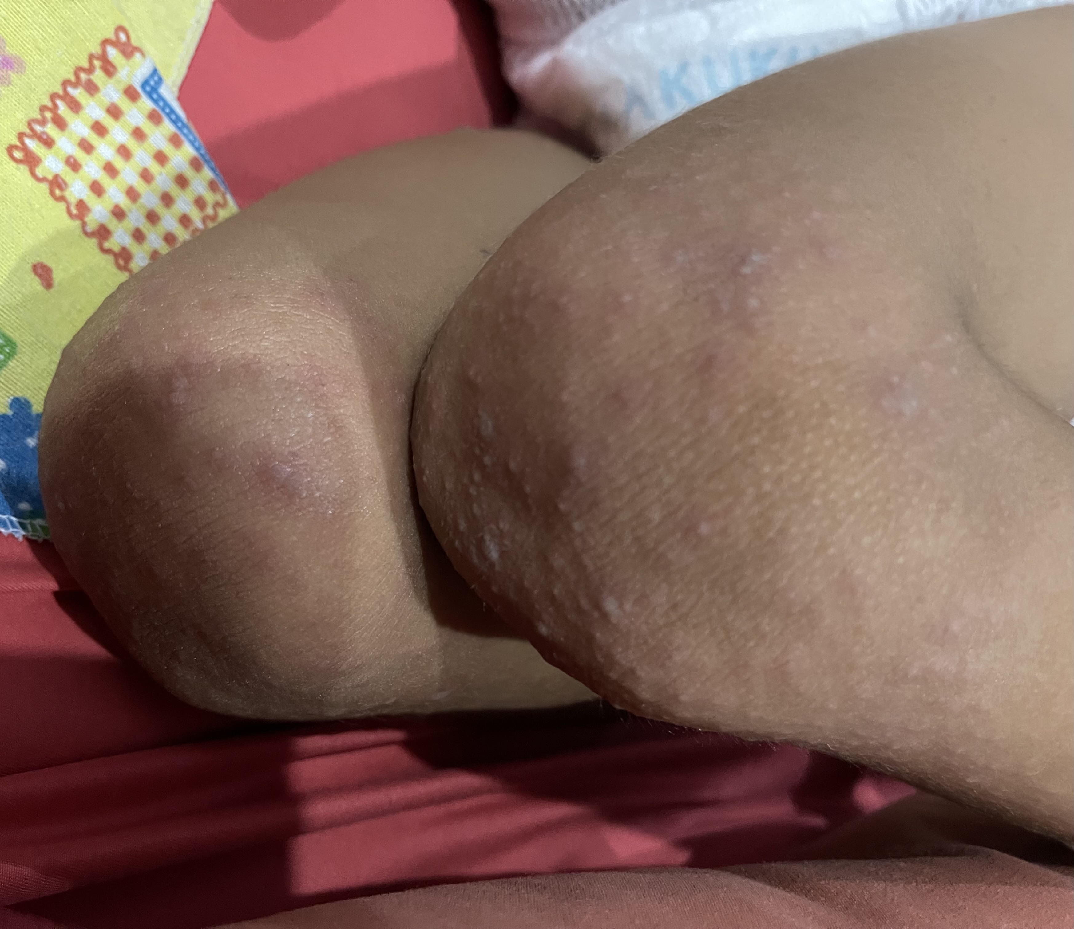 Gejala  ruam pada lutut akibat flu singapura yang banyak menyerang anak-anak di Kabupaten Jembrana.