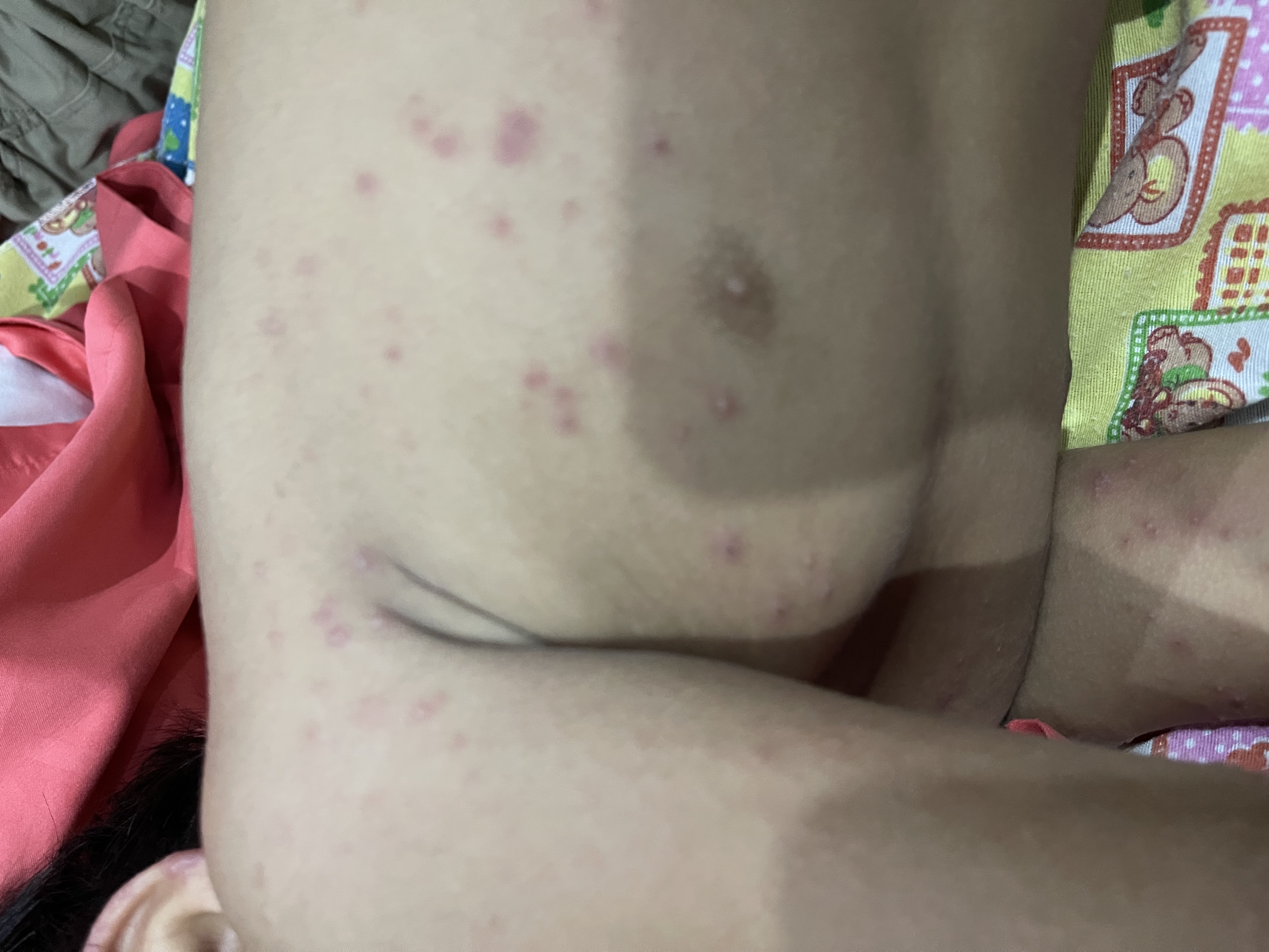 Ruam pada tubuh akibat flu singapura yang menyerang anak-anak di Kabupaten Jembrana