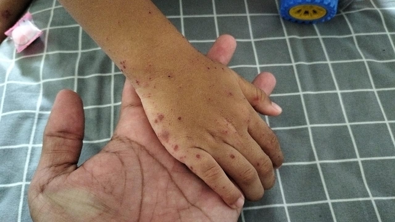 WASPADA: Tangan anak yang terkena flu Singapura. (Istimewa)