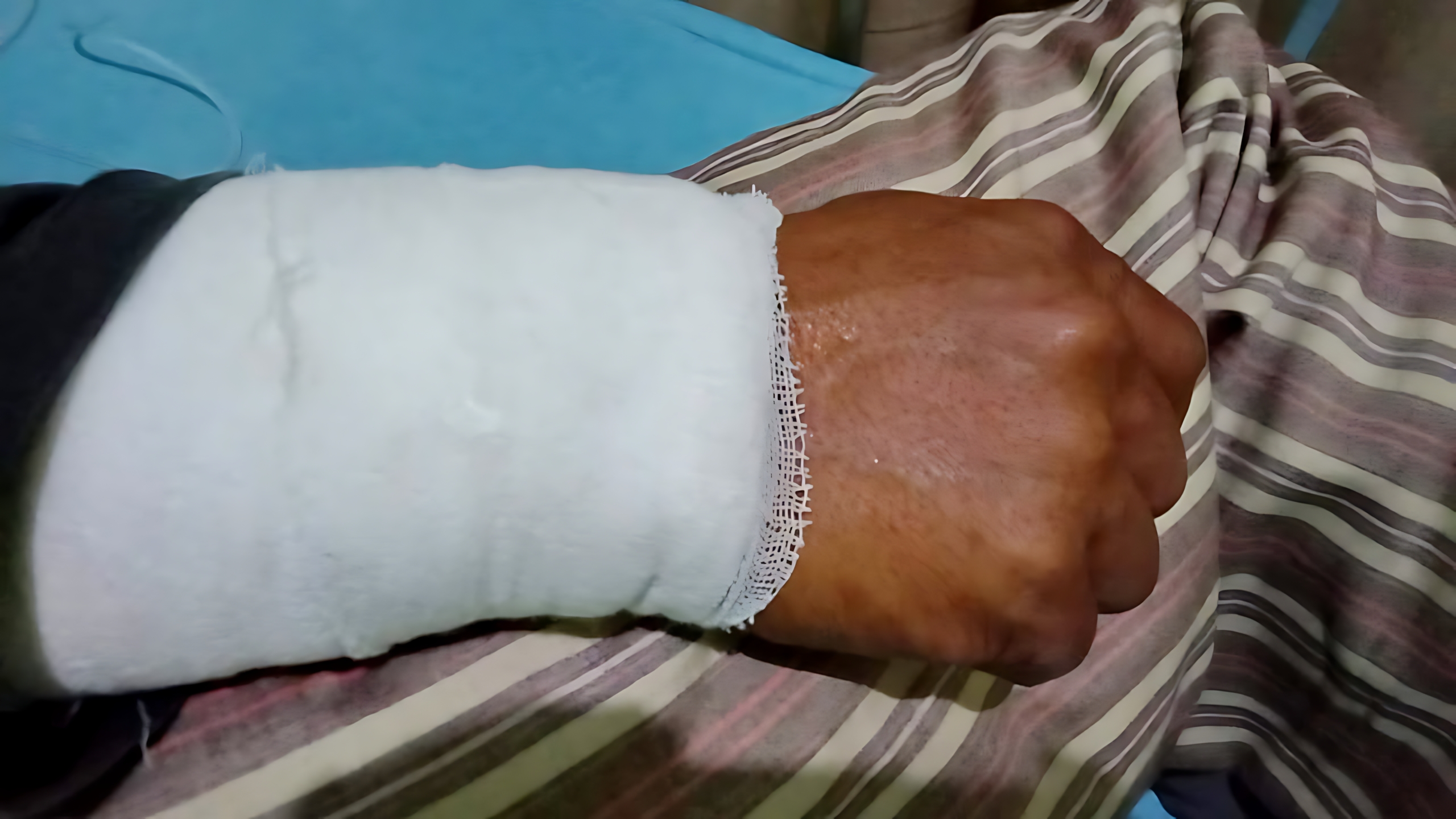 PERAWATAN &ndash; Penampakan tangan petugas Damkar Pekalongan yang sudah dirawat usai digigit ular di RSUD Kajen, pada Kamis (27/11/2025).