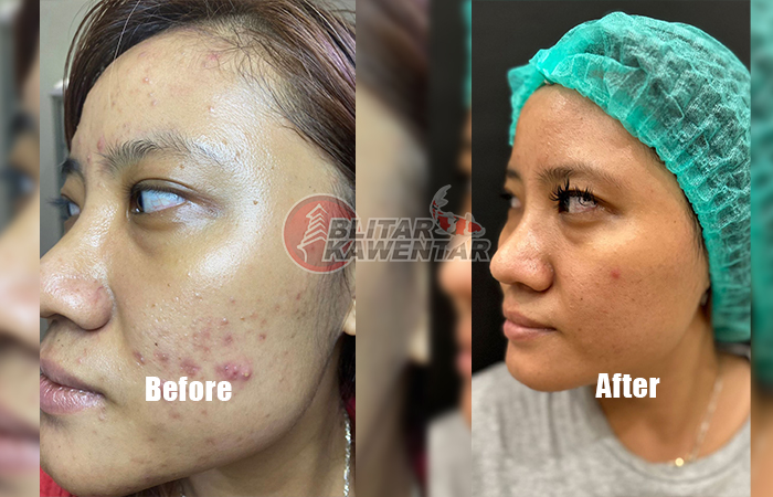 TERBUKTI: Hasil treatment yang memuaskan dari Angelo Care Treatment