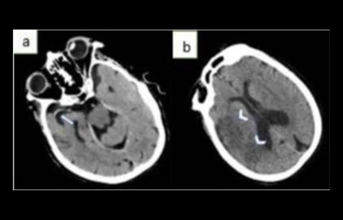 CT-Scan kepala gejala stroke iskemik (a) terlihat Hyperdense Middle Cerebral Artery Sign( HMCAS)di sebelah kanan (tanda panah) (b) Hipoatenuasi parenkim (kepala panah) terjadi setelah satu hari onset.