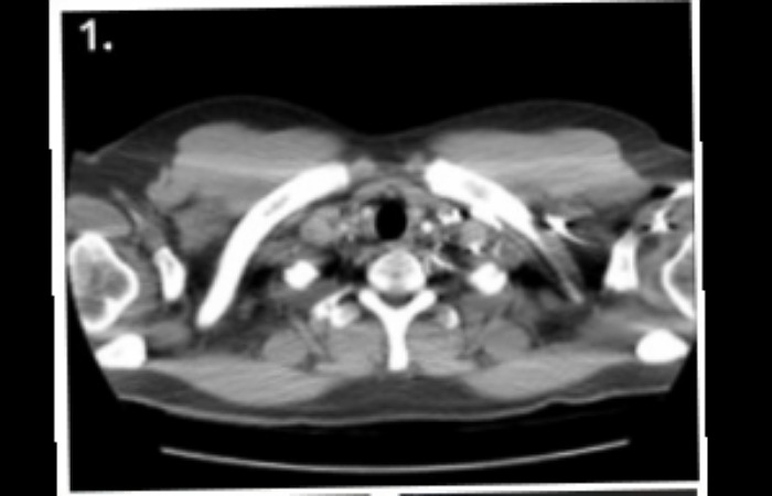 Hasil Pemeriksaan Normal CT-Scan Dada dengan kontras dan Gambar
