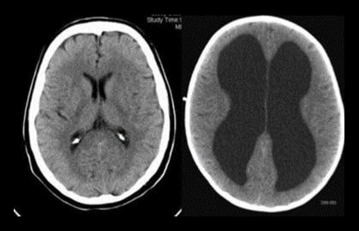 Gambar 1. Kiri: CT scan kepala (axial) normal. Tidak tampak pelebaran ventrikel lateralis kanan kiri. Kanan: CT scan kepala (axial) pada pasien dengan hidrosefalus dengan pelebaran ventrikel lateralis