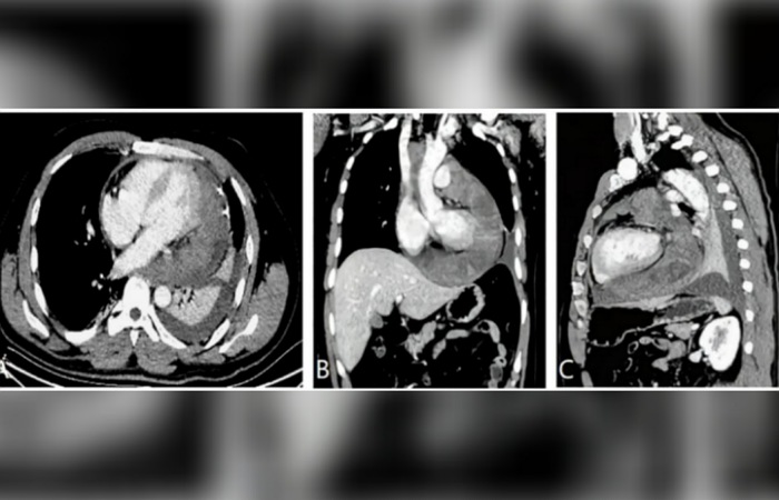 (A) CT aksial menunjukkan massa perikardial kiri besar dengan efusi ringan. (B) Rekonstruksi koronal memperlihatkan tumor mengelilingi aorta desendens, vena superior, dan arteri pulmonalis. (C) Rekon