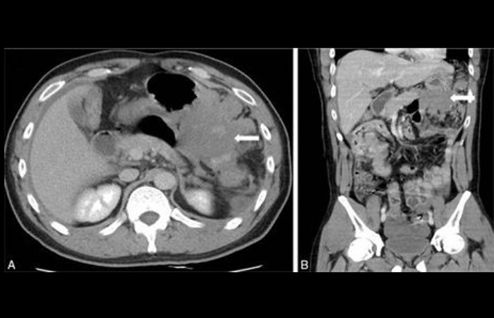 Gambar 1. (A). Tampilan axial dari CT abdomen dan gambar (B). Tampilan koronal dari CT abdomen dengan peningkatan yang menunjukkan adanya lesi besar dengan kontur lobular yang homogen serta sedikit hi