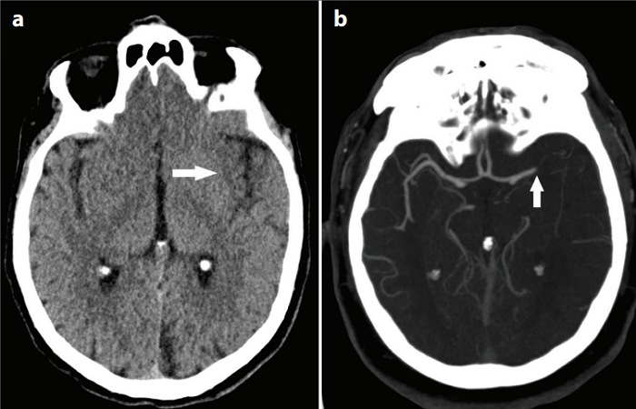 Gambar (a) menunjukkan area gelap halus di otak kiri pada CT scan tanpa kontras&mdash;tanda awal stroke. Gambar (b) dari CT angiografi memperlihatkan adanya penyumbatan di arteri serebri media kiri.