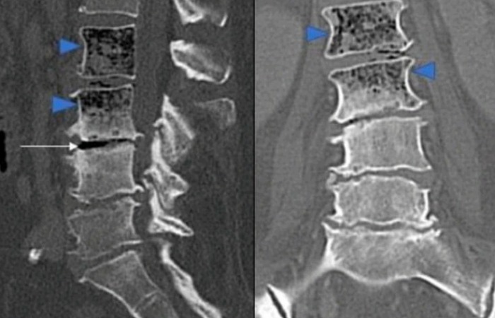 CT scan non kontras menunjukkan intraosseous air foci atau pumice stone sign pada tulang belakang lumbar (Saha et al., 2024)
