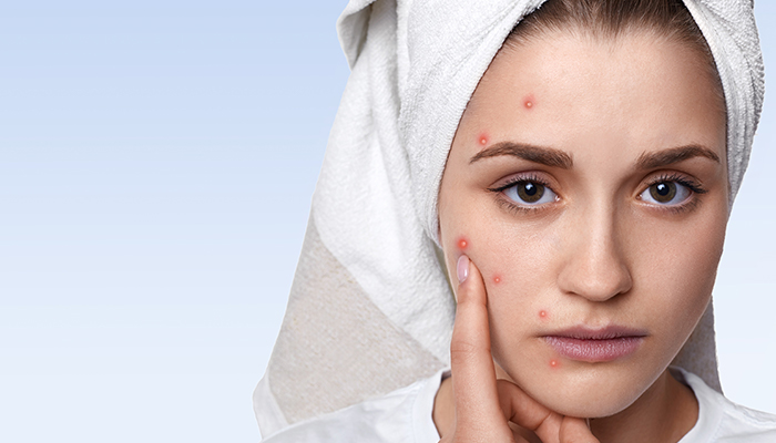 Munculnya Jerawat Sebagai Tanda Usus Kotor