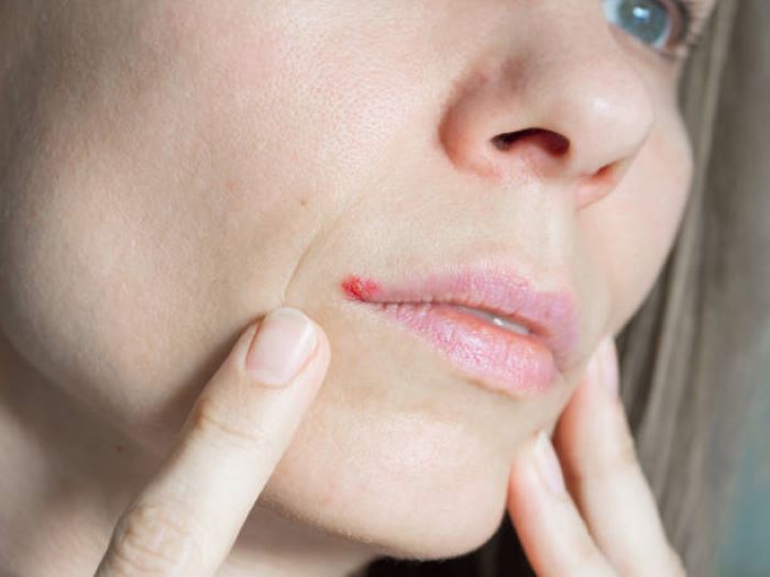 Ilustrasi bibir kering dan pecah-pecah (ISTOCKPHOTO.COM)