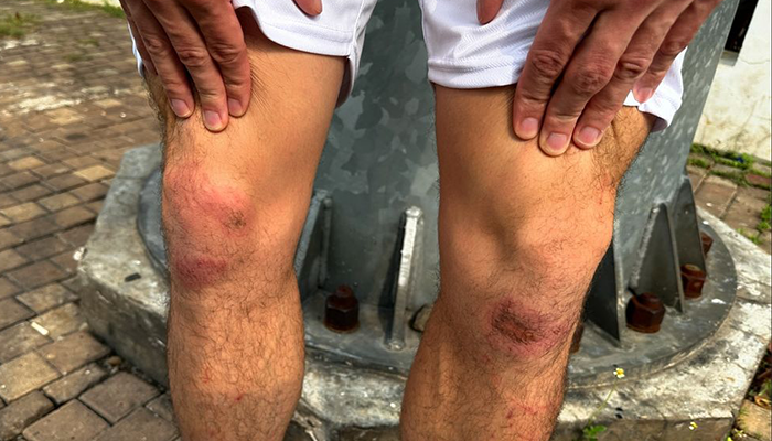 Luka lutut dialami oleh Thom Haye usai slebrasi knee slide di GBK.