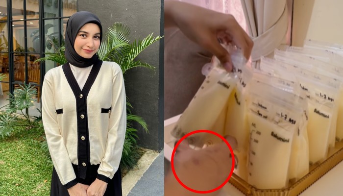 Tangan lebam Cut Intan Nabila akibat KDRT.