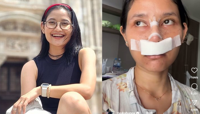 Riyuka Bunga jalani operasi plastik untuk memancungkan hidungnya.