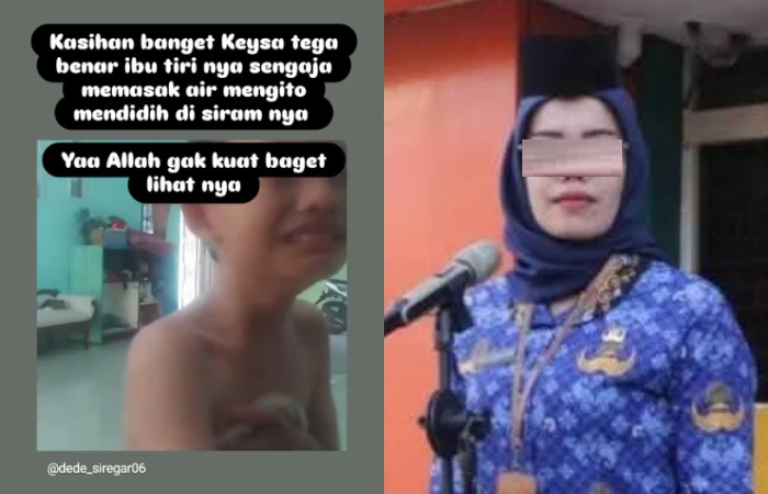Diduga oknum ASN PPPA siram anak tiri dengan air panas.