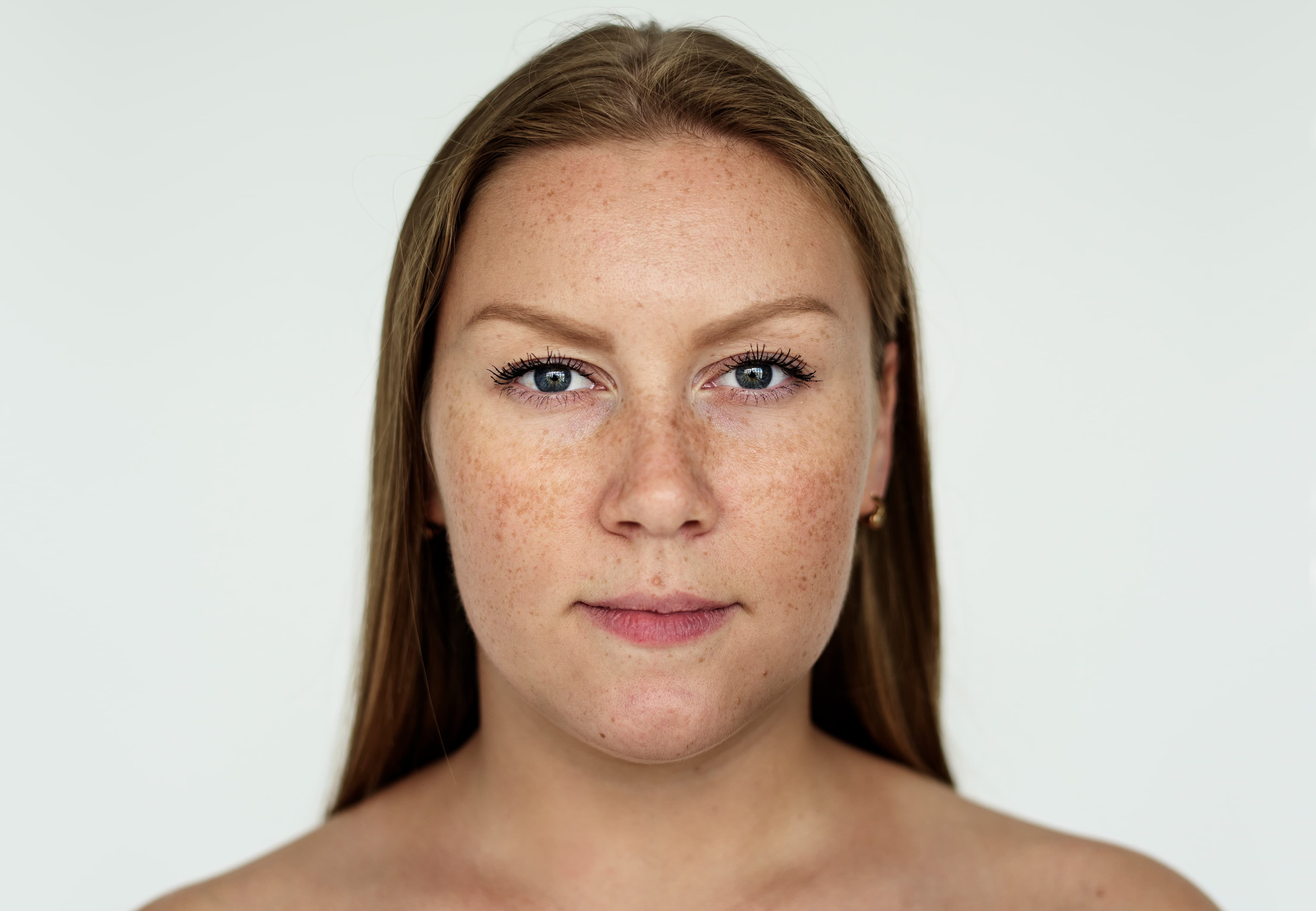 Illustrasi melasma.