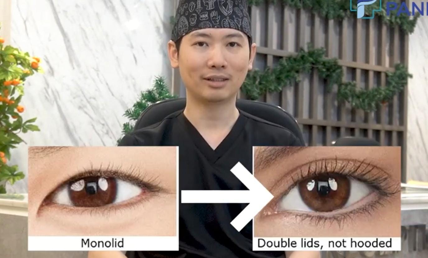 Ilustrasi sulam eyelid agar punya lipatan mata ganda.