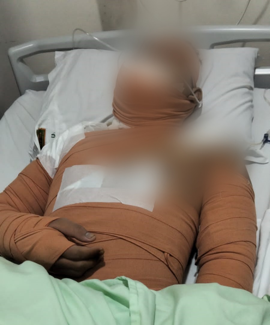 Karyawan dapur SPPG Mojosongo, Kevin, tersiram minyak panas di dini hari. Diduga mengantuk, Kevin hilang keseimbangan & alami luka bakar.