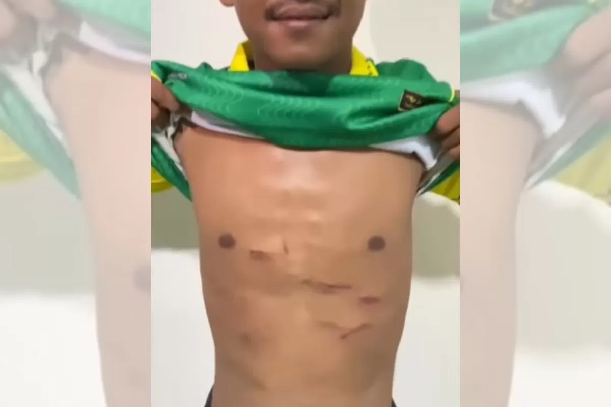 Kondisi dada Firman Nugraha yang robek kecil tendangan horor Muhammad Hilmi.