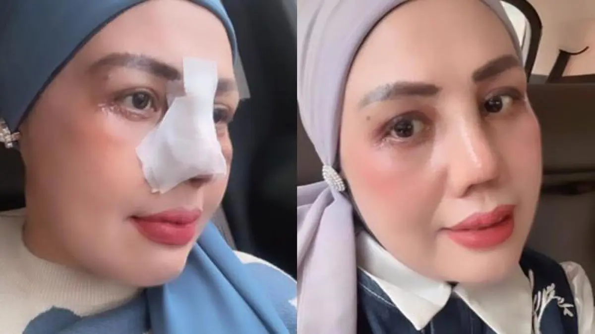 Elly Sugigi menuai komentar negatif netizen setelah melakukan prosedur operasi plastik hidung (rhinoplasty) di RS Triadipa Jakarta demi mempercantik diri. (Instagram/@ellysugigi_real_)