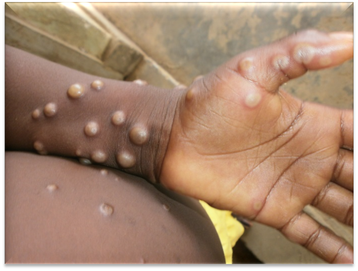 Gejala penderita yang terjangkit Virus Monkey Pox (WHO)