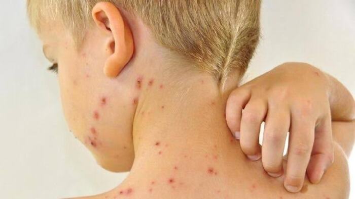 Anak rawan terpapar Mpox karena daya tahan tubuhnya masih lemah