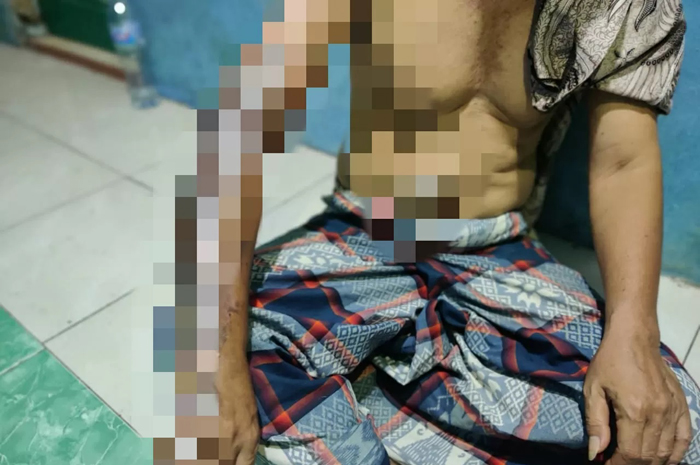 TUNJUKKAN: Hartoyo, seorang marbot MushollaBaiiturohman di Desa Samborejo, Kecamatan Tirto, Kabupaten Pekalongan menunjukkan luka bakar, Rabu (6/11).