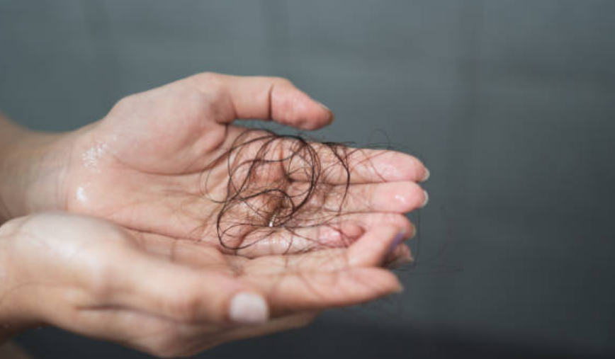 Ilustrasi rambut rontok