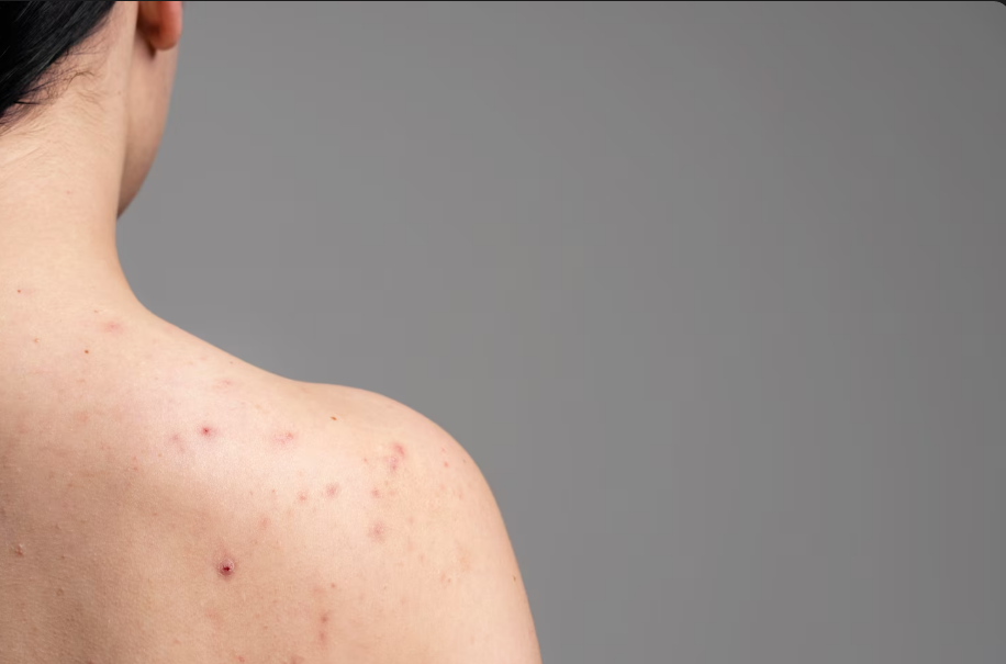 Fungal acne
