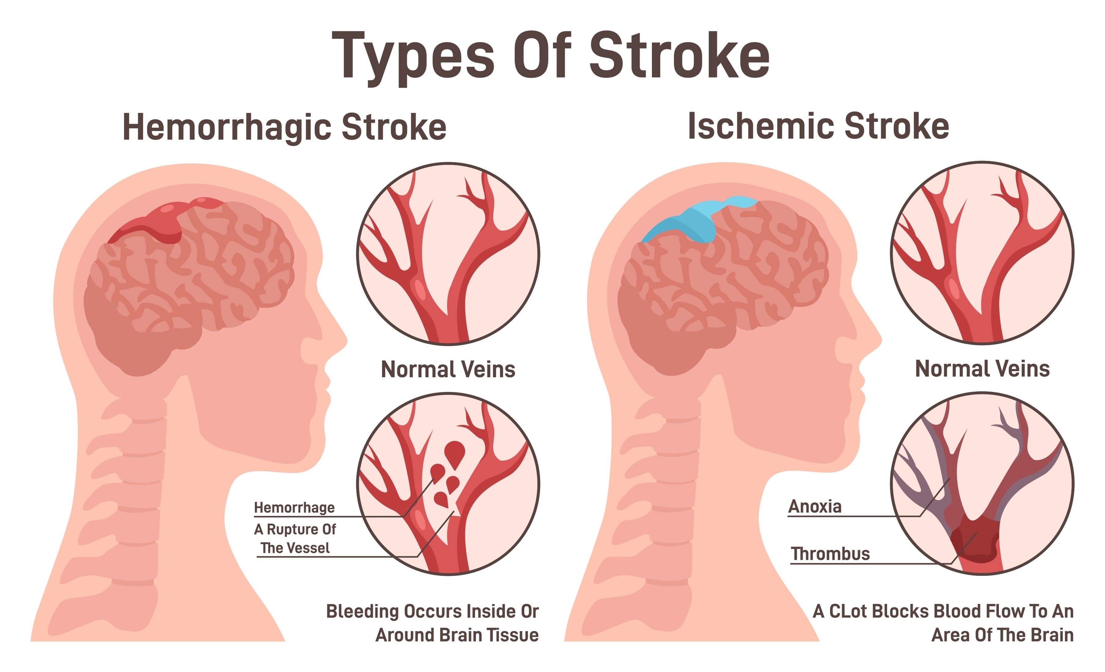 Foto Ilustrasi Types Of Ttroke (Shutterstock)