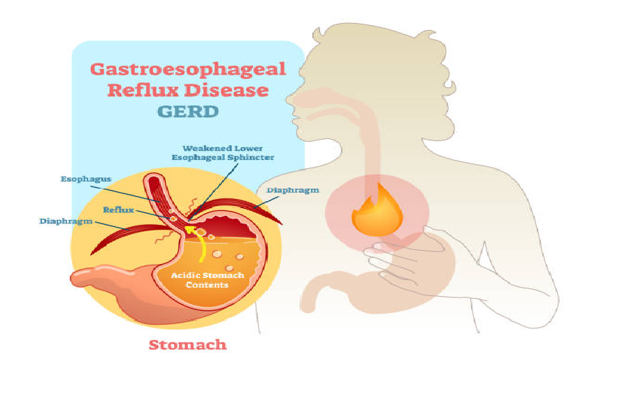Perbedaan Sakit Maag, Asam Lambung, dan GERD