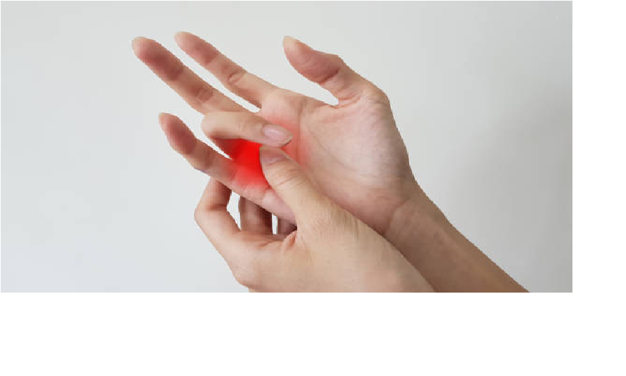 ilustrasi trigger finger (iStock)