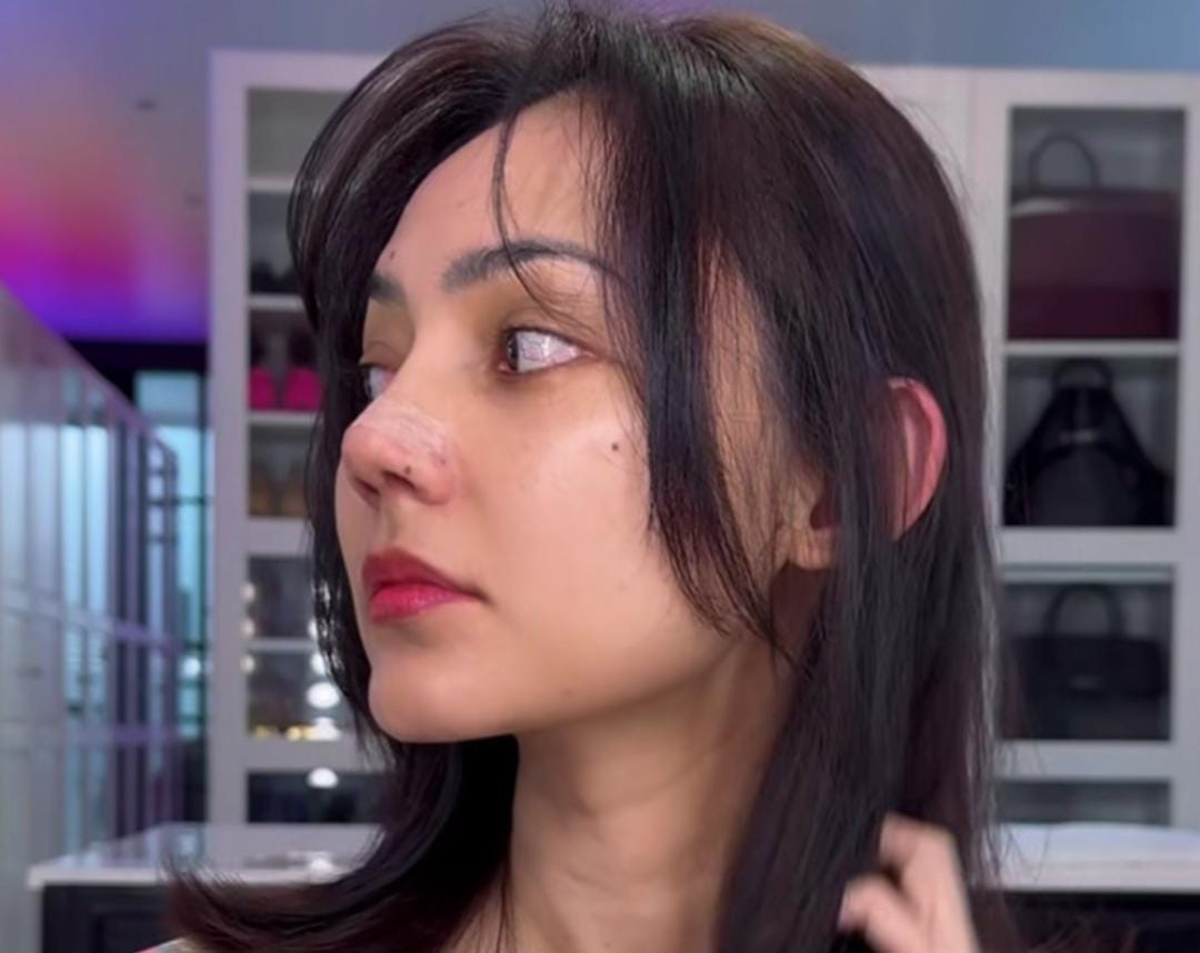 Rina Nose lakukan operasi hidung (Foto: instagram @rinanose16)