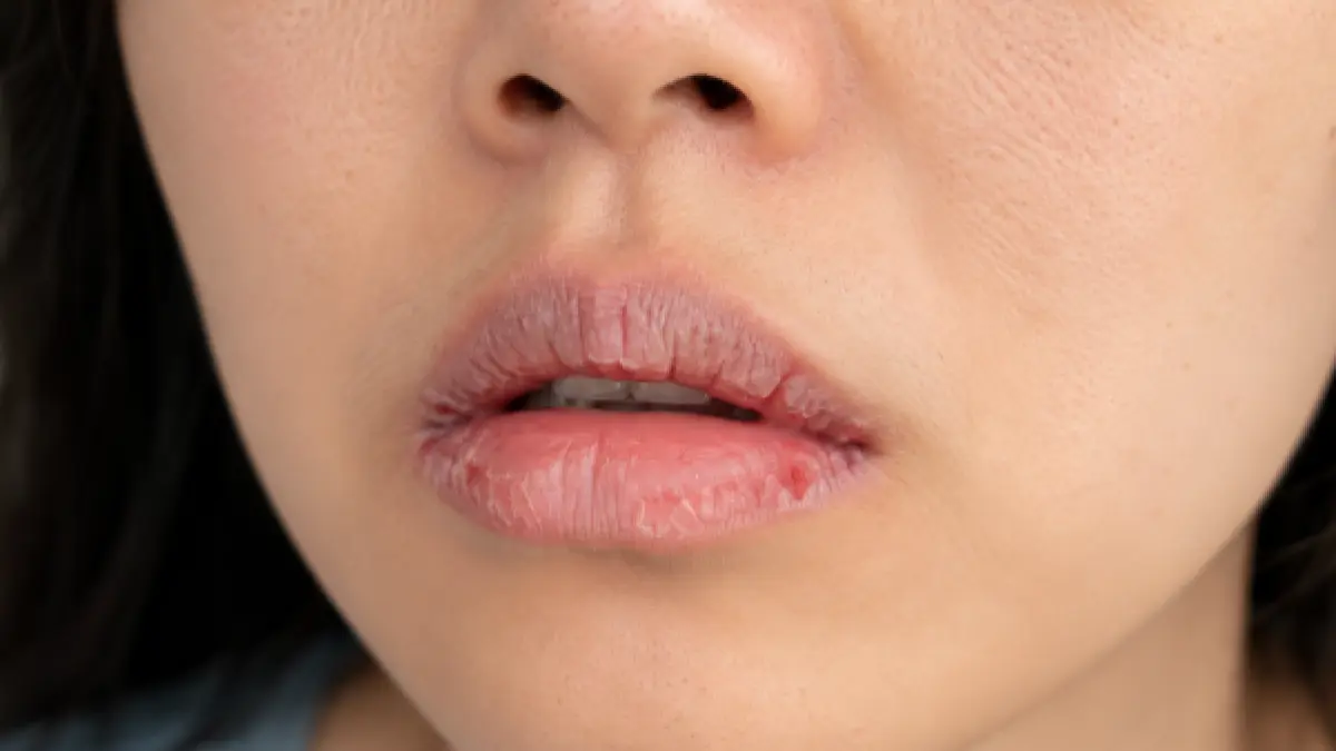 Ilustrasi seseorang mengalami bibir pecah-pecah yang ditandai dengan kulit bibir kering, mengelupas, dan retak. Kondisi ini dapat dipicu oleh dehidrasi, cuaca ekstrem, kebiasaan menjilat bibir, hingga kekurangan nutrisi.