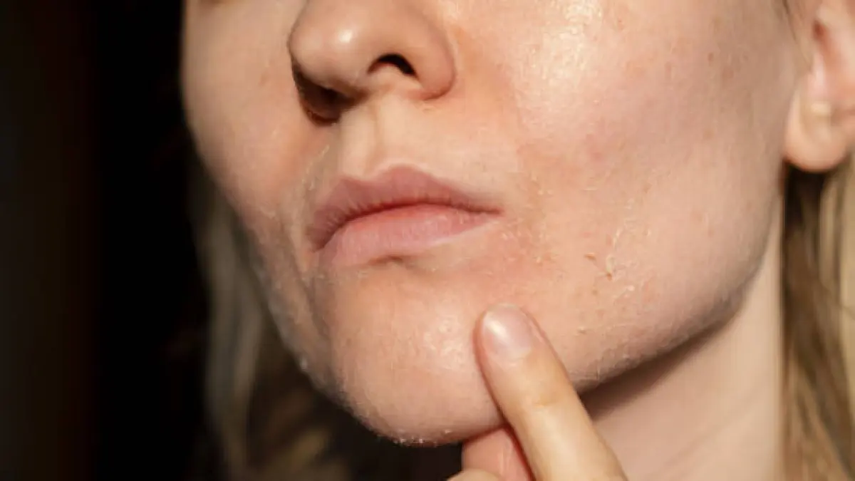 Ilustrasi kulit kering