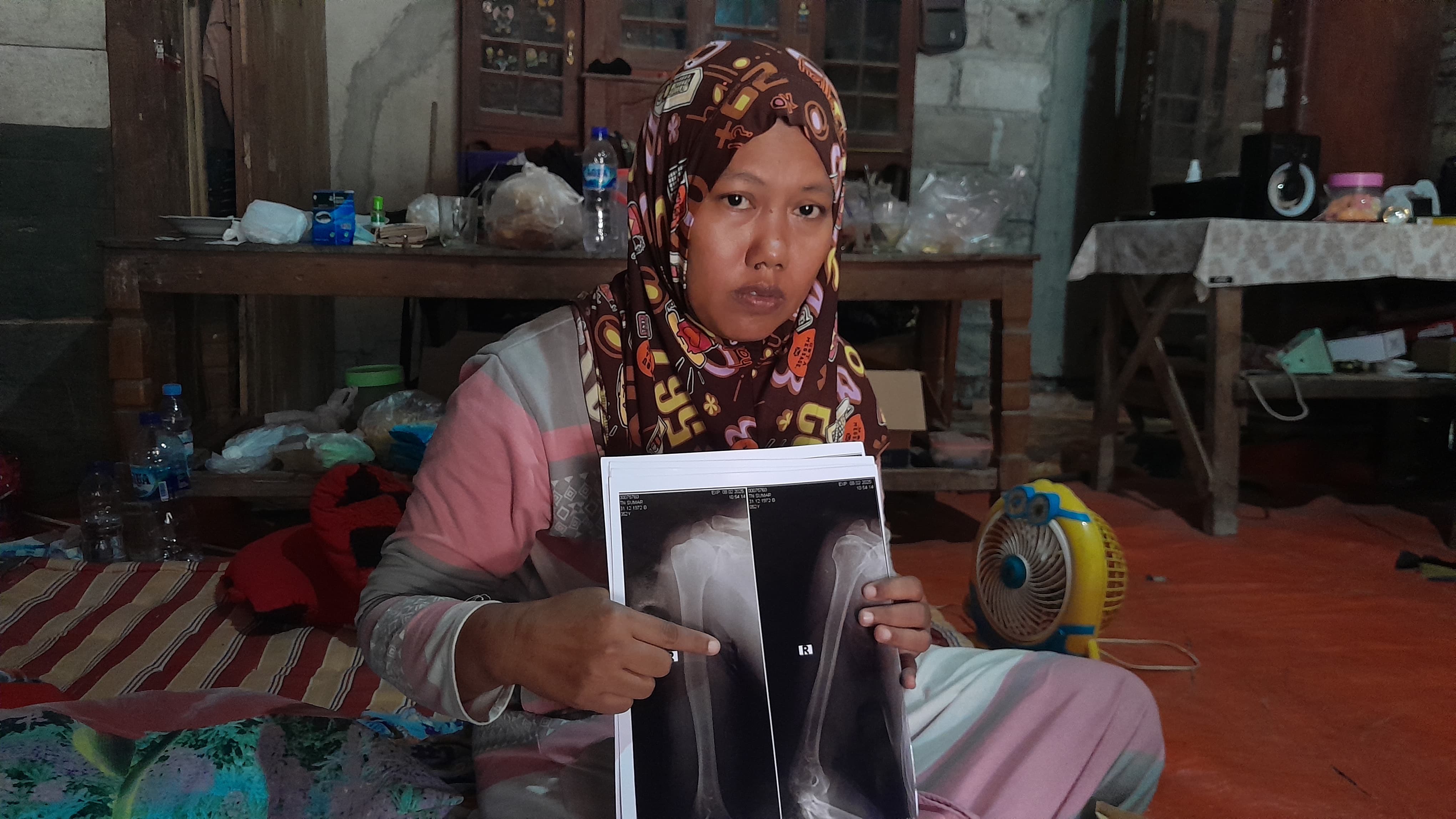 KONDISI KORBAN: Listiana menunjukkan hasil X Ray suaminya yang mengalami luka dan patah tulang. (ARIF FAKHRIAN KHALIM/RADARPATI.ID)