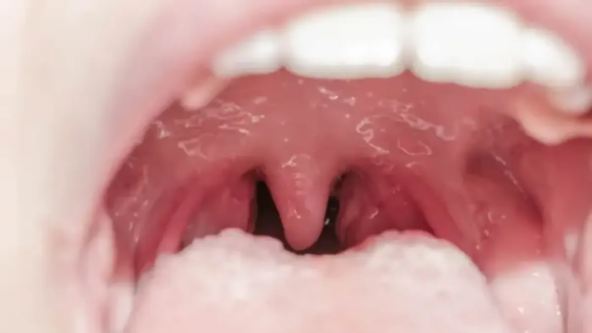 Tonsil atau amandel. (Ilustrasi Hellosehat)