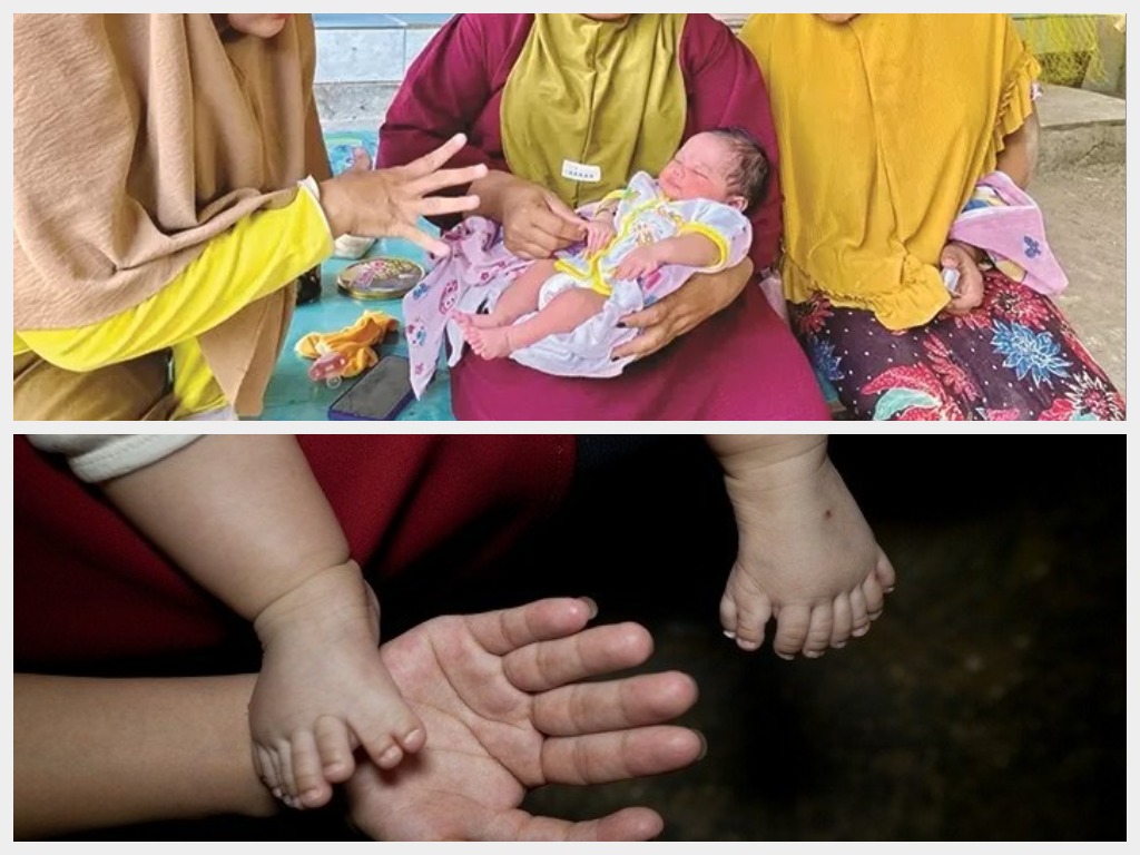 Viral Bayi Lahir 24 Jari di Sampang, Dokter Spesialis Anak Uangkap Istilah Ini. (Kolase RadarBangkalan.id/RadarMadura,alodokter)