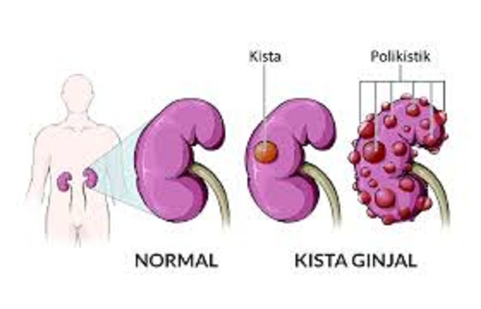Ilstrasi gambar ginjal normal dan mengalami kista.