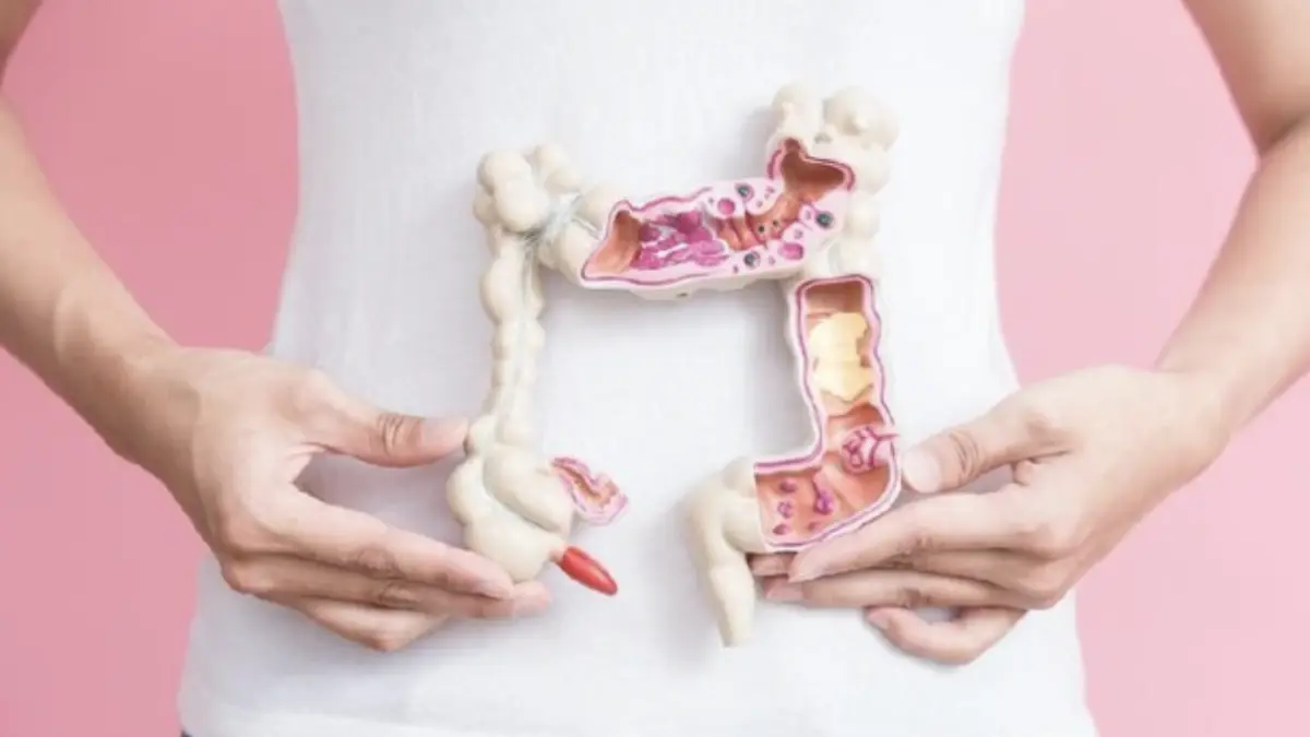 Foto: Ilustrasi kanker usus besar (Istock)